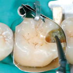 Un nuovo materiale per i restauri diretti: le resine composite siloraniche