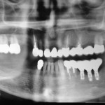 Espansione controllata della cresta alveolare atrofica a scopo implantare