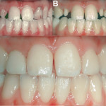 Controllo clinico, a un anno, di corone in zirconia cementate con G-cem Automix: valutazione della sensibilità post-operatoria e di altri parametri