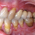 Lichen planus gengivale: considerazioni preliminari nella programmazione chirurgica implantare