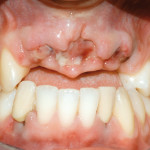 Terapia ortodontico-implantare nei traumi dento-alveolari