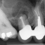 Il trattamento delle lesioni apicali con laser a Erbio: esperienza clinica