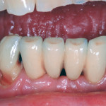 La riabilitazione protesica di impianti immediati nel sito post-estrattivo