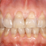 Risoluzione di un caso complesso di pigmentazione da tetraciclina