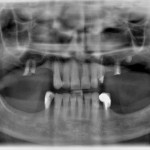 Riabilitazione parziale del mascellare edentulo posteriore con applicazione del principio All-on-4