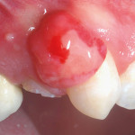 Terapia combinata di un’epulide gengivale e frattura coronale di un premolare permanente