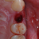 Strategia protesica minimamente invasiva negli impianti post-estrattivi