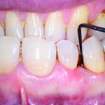 Chirurgia parodontale rigenerativa di un difetto osseo angolare in zona estetica: analisi della letteratura e caso clinico