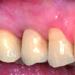 Estetica e tessuti molli in implantologia