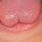 Frenulectomia laser-assistita in un paziente pediatrico – Caso clinico