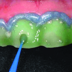 Valutazione del croma dentario dopo utilizzo di un nuovo sistema di sbiancamento professionale domiciliare al 35% di perossido di idrogeno