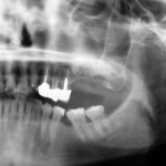 Il trattamento delle sinusiti conseguenti a rialzo del seno mascellare mediante endoscopia sinusale (FESS) e approccio intraorale