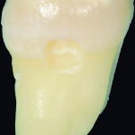 Microinfiltrazione di resine composite fluide a ridotta contrazione su substrato smalteo e dentinale: studio in vitro