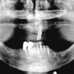 Aumento verticale di cresta con griglia in titanio e PDGF in una cresta con grave atrofia verticale Caso clinico