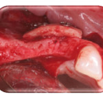 Complicanze in un caso di innesto di osso autogeno a blocco e loro successiva gestione