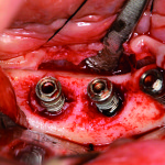 Tecnica rigenerativa innovativa per la risoluzione di perimplantiti con laser Er:YAG, basata su diagnosi microbiologica