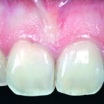 L’impiego delle tecnologie digitali nella diagnosi protesica e nella realizzazione della protesi