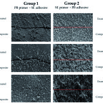 Influenza di un primer MDPB sulla formazione di biofilm da parte di Streptococcus mutans sulla superficie di restauri di prima classe: studio in vitro