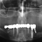 Chirurgia orale: patologie sistemiche che aumentano il rischio d’infezione chirurgia-orale-patologie-sistemiche