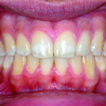 Trattamento dei difetti dello smalto attraverso l’uso combinato di derivati della caseina e agenti sbiancanti