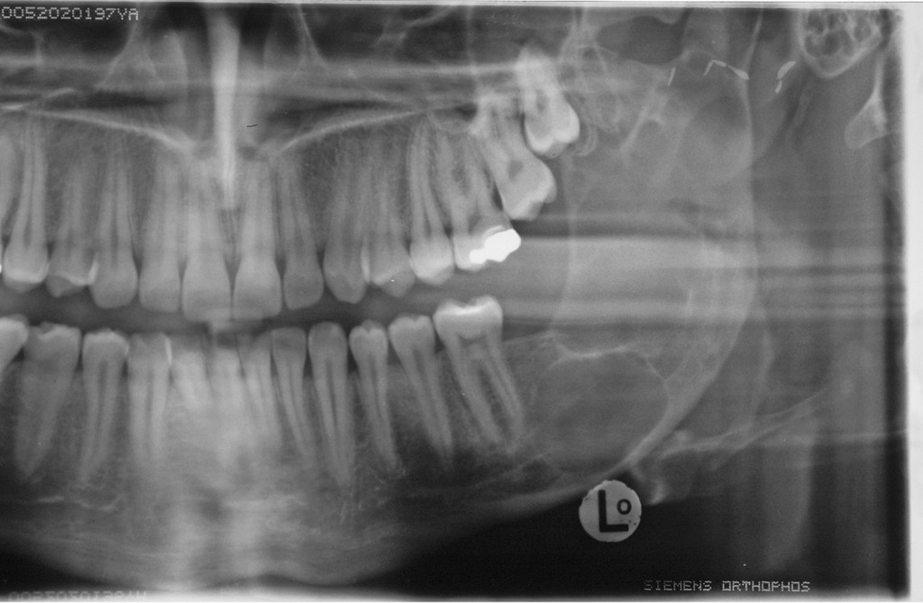 trattamento del tumore odontogeno cheratosico (cheratocisti)