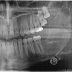 Attuali protocolli nel trattamento del tumore odontogeno cheratosico (cheratocisti): revisione della letteratura trattamento del tumore odontogeno cheratosico (cheratocisti)