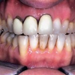 “Interproximally connected flap” nella riabilitazione implanto-protesica