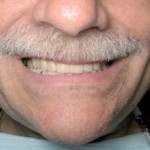 Full mouth rehabilitation utilizing traditional fixed and removable prostheses