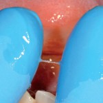 La saliva come reperto diagnostico: patologie locali e sistemiche