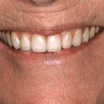 Rehabilitation of atrophic jaws using the All-on-4 Concept