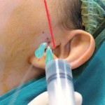 La terapia chirurgica dell’Internal Derangement