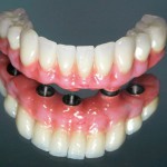 Riabilitazioni implanto-protesiche full-arch: tecnica di provvisorizzazione immediata