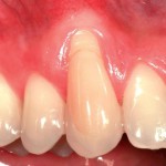 Trattamento estetico di una recessione gengivale