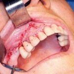 Accesso al seno mascellare