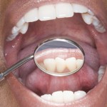 Denti inclusi: prevenzione, diagnosi, terapie e prognosi