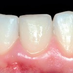 Restauro conservativo diretto di un incisivo centrale fratturato