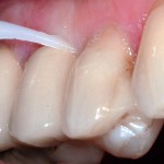 Il rischio carie in odontoiatria ricostruttiva