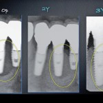 Trattamento predicibile di perimplantiti