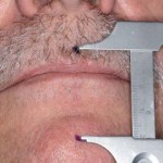 Determinazione cefalometrica della dimensione verticale