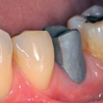 Impronta con scanner intraorale digitale Cadent iTero