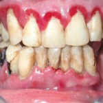 Fumo e salute oro-facciale: analisi della letteratura e razionale scientifico