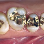 Oro: un’odontoiatria fuori dal tempo o una reale alternativa clinica?