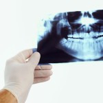 Uso aggiuntivo di metronidazolo e amoxicillina nel trattamento delle infezioni parodontali