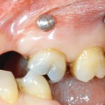 Le miniviti ortodontiche