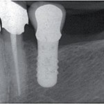 Efficacia a lungo termine degli impianti corti