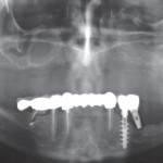 Chirurgia orale: patologie sistemiche che aumentano il rischio d’infezione
