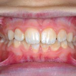 Trattamento dei difetti dello smalto