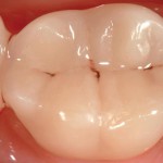 Usura occlusale di 2 ceramiche: indicazioni cliniche da uno studio split-mouth