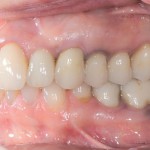 Quali materiali in protesi fissa oggi?