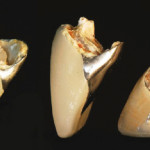 Riabilitazione, con perni endocanalari, di elementi dentali trattati endodonticamente